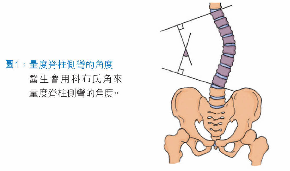 量度脊柱侧弯的角度医生会用科布氏角来量度脊柱侧弯的角度.
